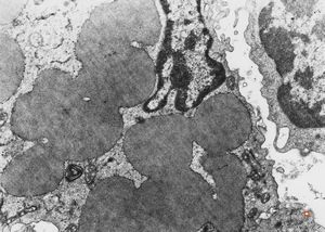 F,32y. | lymphadenopathy - clin. dysglobulinaemia